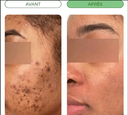 Savon biologique anti-tâches au Curcuma & Acide Kojic